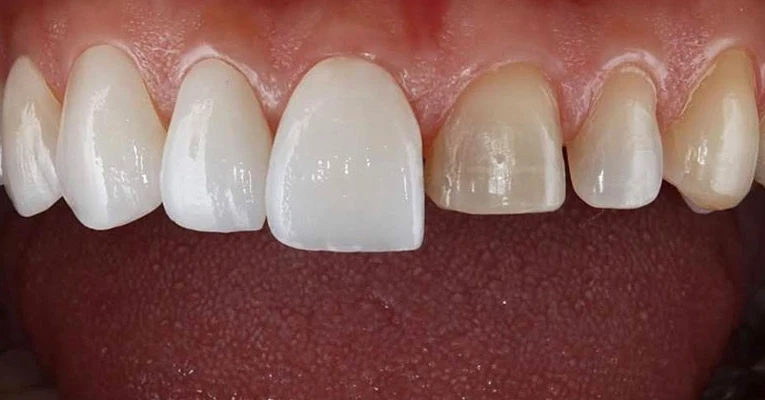 tooth cutting
