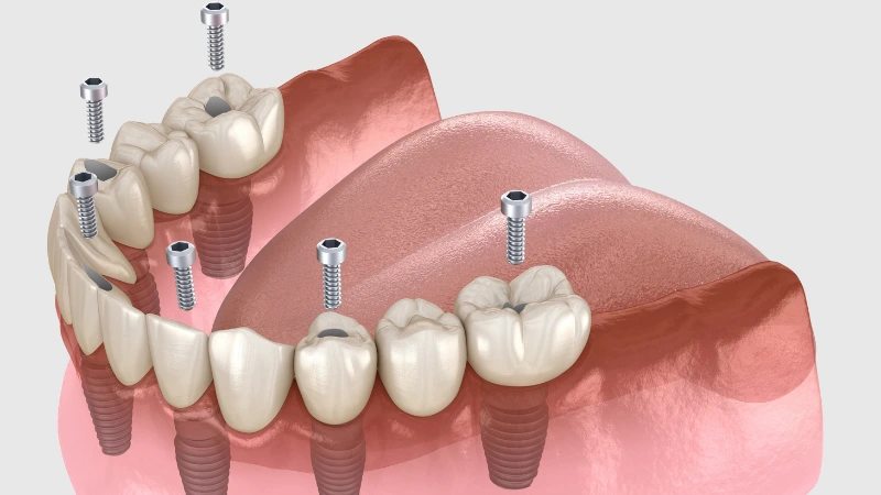 All-on-Six Implants