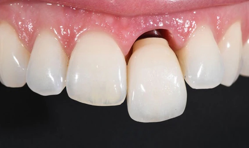 loose teeth
