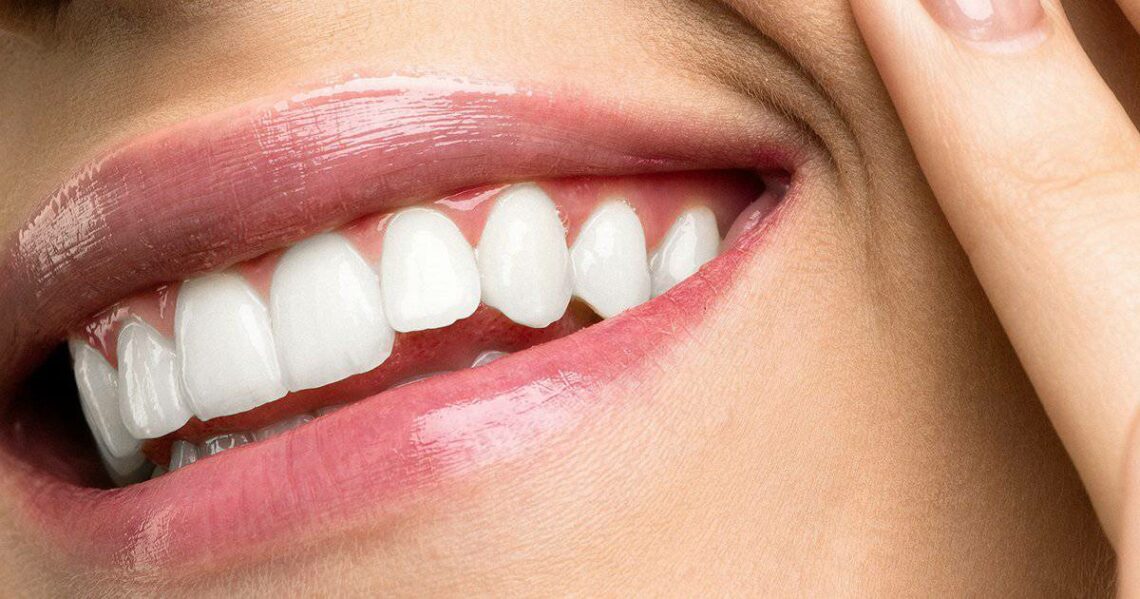 can-veneers-be-white | Livera Dental Clinic