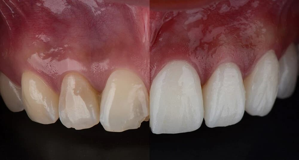 What are Porcelain Veneers and How Are They Made? | Livera Dental Clinic