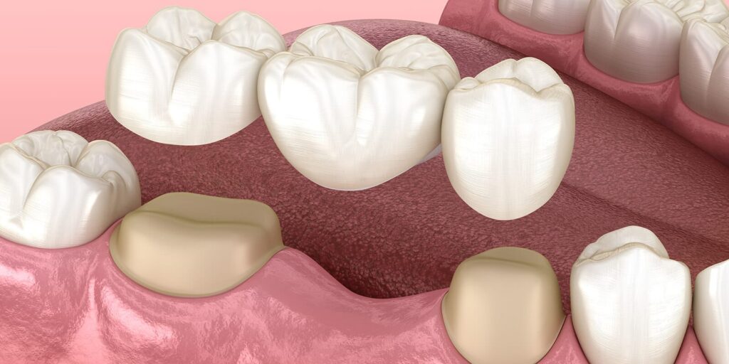 dental crown