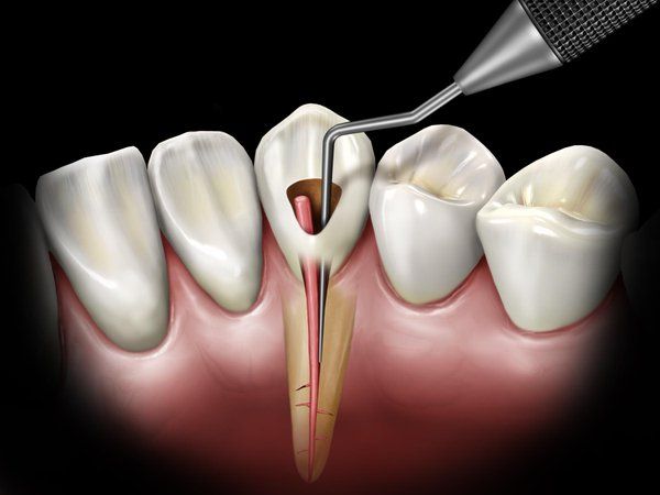 dental nerve