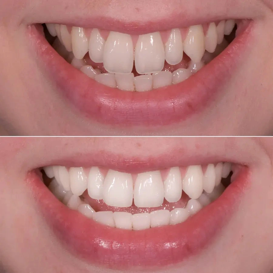 teeth shaping