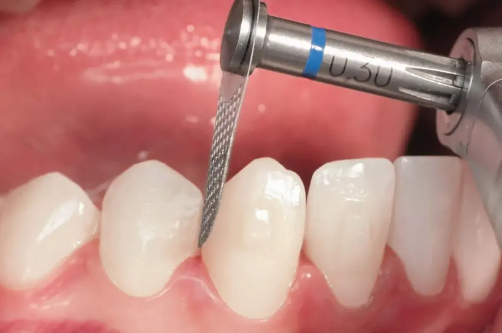 teeth shaping