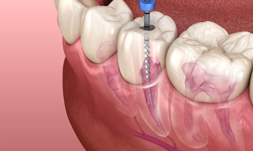 Endodontic Treatment