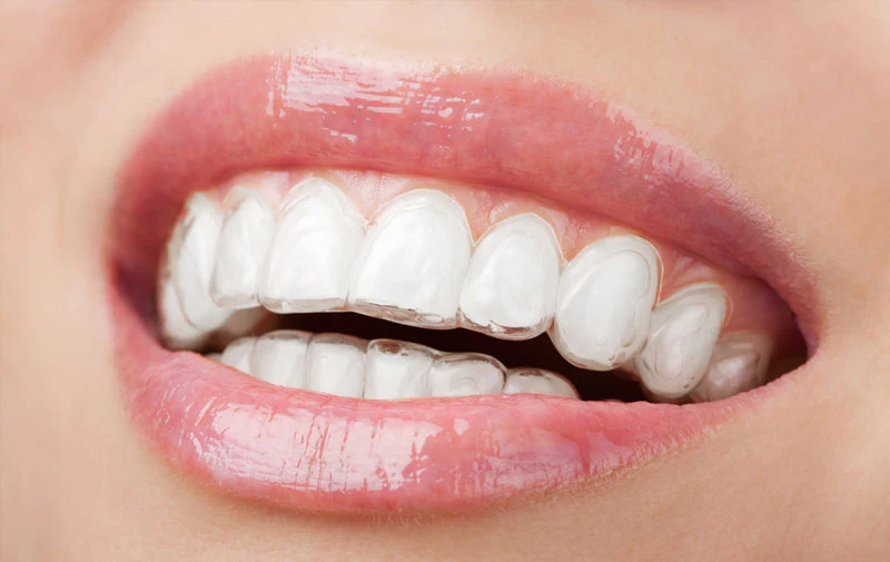 invisible braces