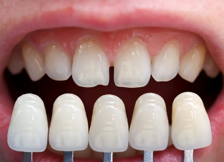 Lumineers coating