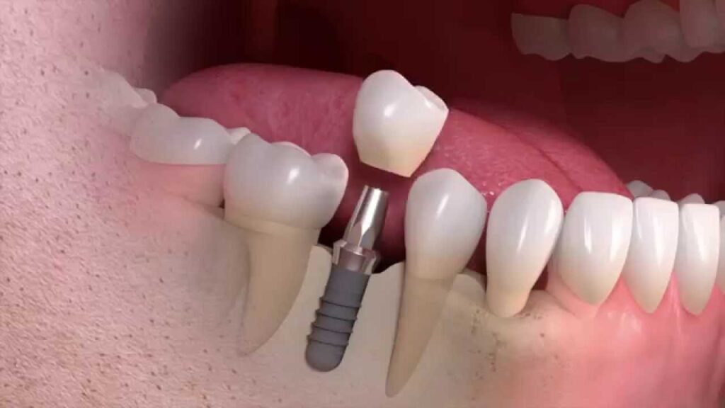 Straumann Implants from A to Z | Livera Dental Clinic