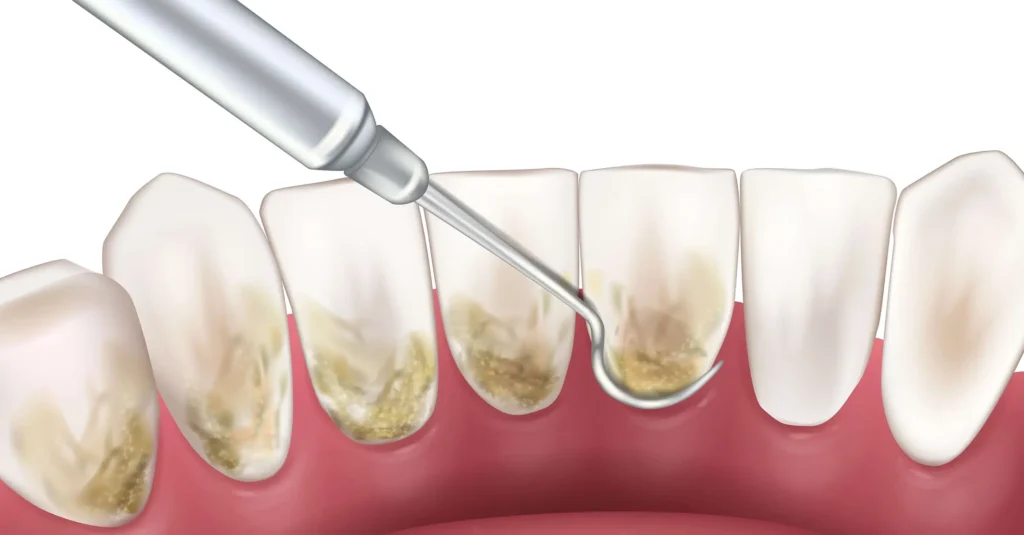 Gum Disease