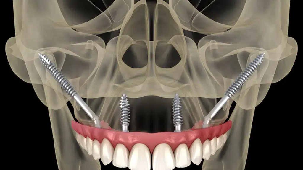 Zygomatic Implant