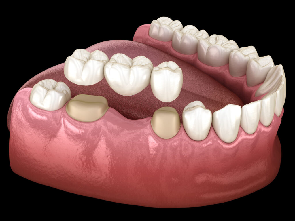 What Should Be Considered After Tooth Cutting? | Livera Dental Clinic