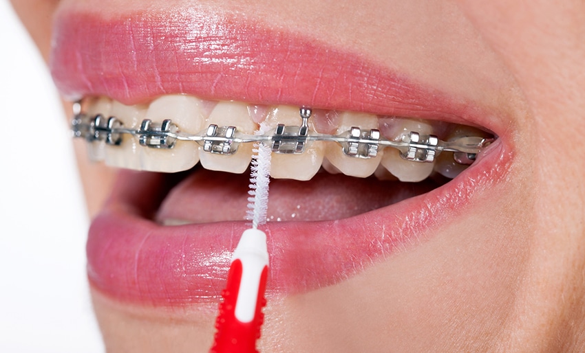 braces