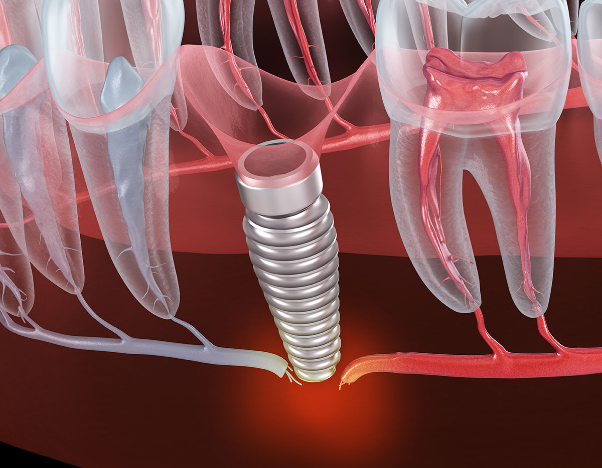 Can Dental Implants Be Removed? Clinical and Scientific Analysis | Livera Clinic