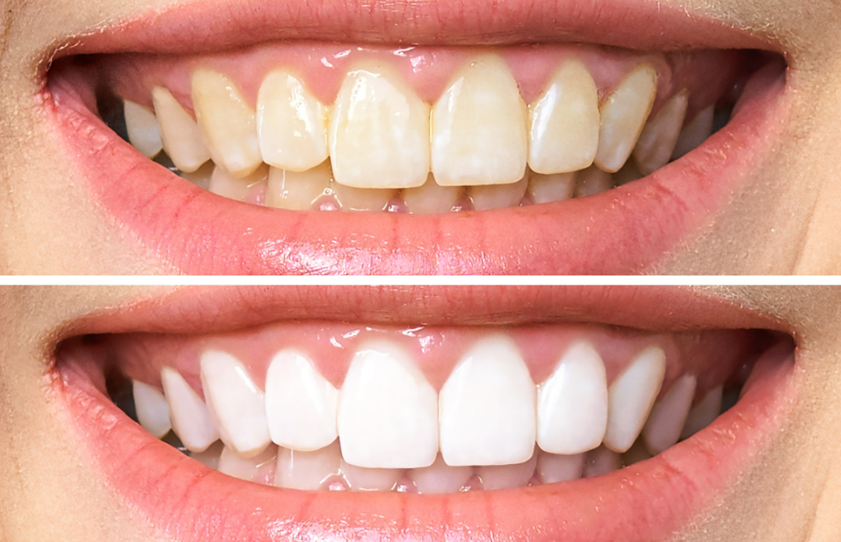 Veneer Fiyatları: 3 Ülke Karşılaştırması