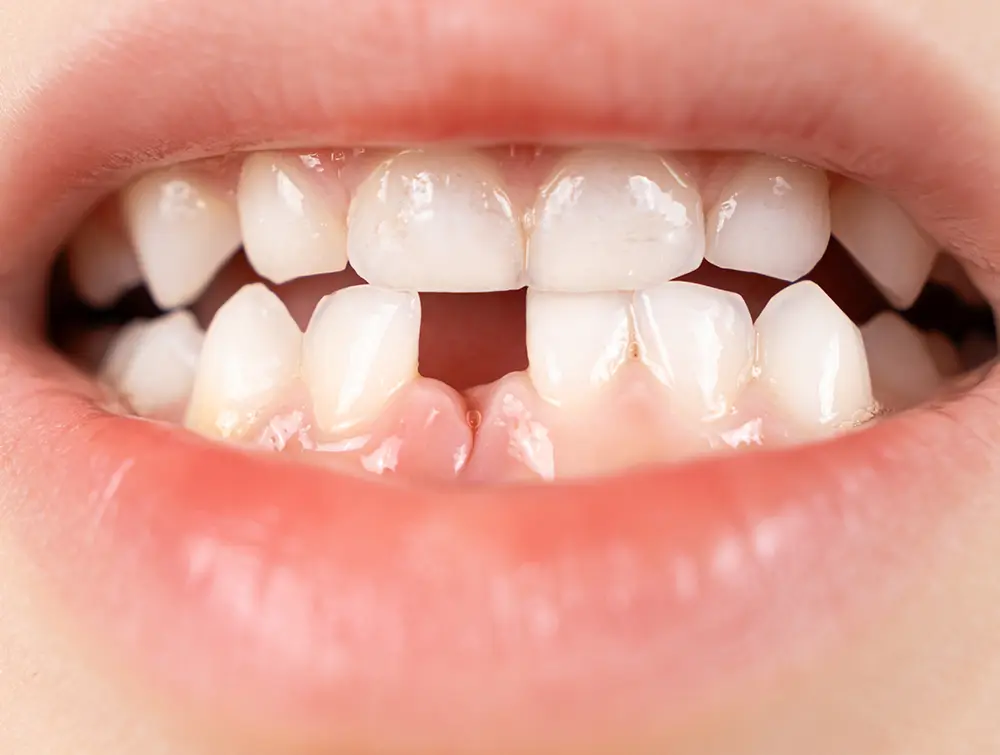 What Happens if a Tooth is Swallowed? Risks and What to Do