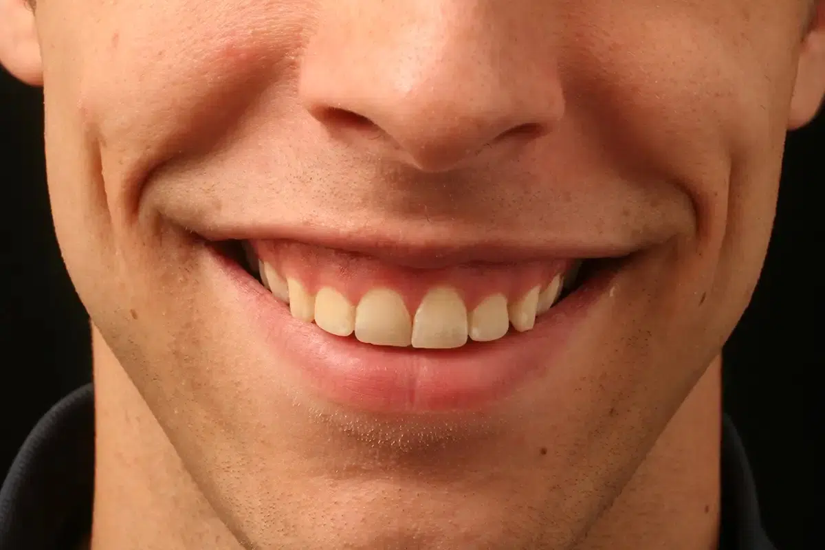 Gummy Smile (Diş Eti Gülüşü): Nedenleri, Tedavi Yöntemleri ve Merak Edilenler