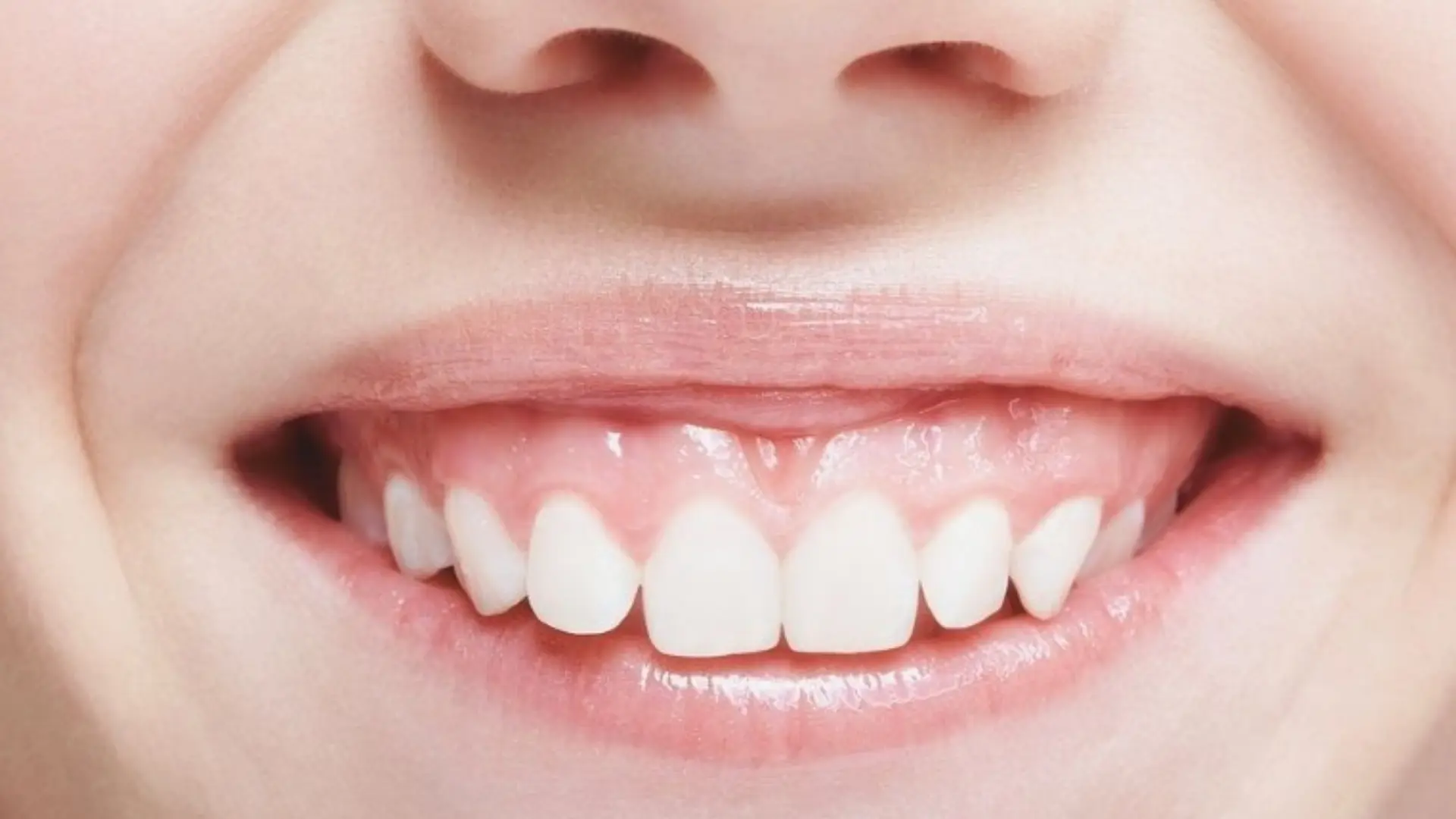 Gum Smile: Causes and Solutions – Everything You Need to Know About Gummy Smiles