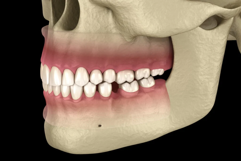 Symptoms of Tooth Shifting and How to Correct It