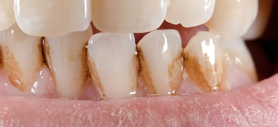 How to Remove Tooth Stains With Natural Products?