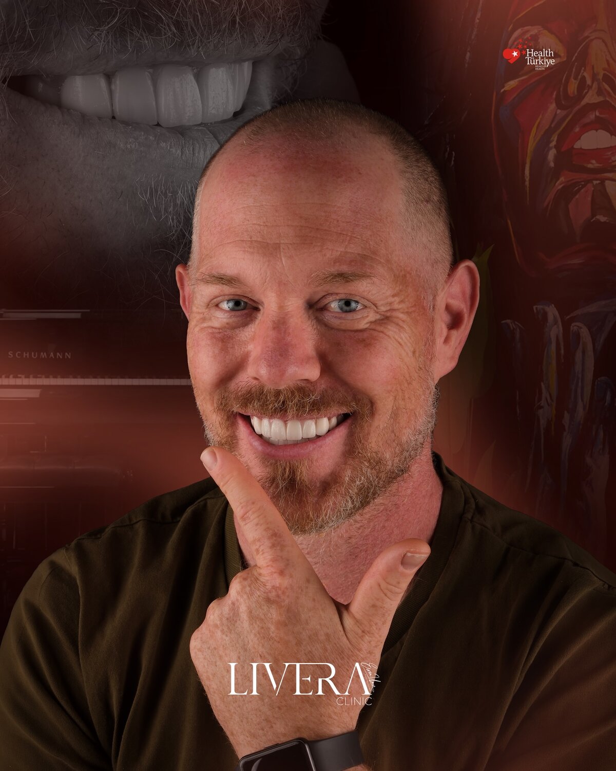 Clear Aligners